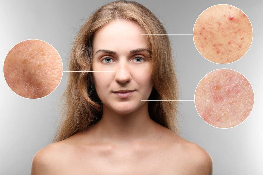 Rashes on the face due to parasites